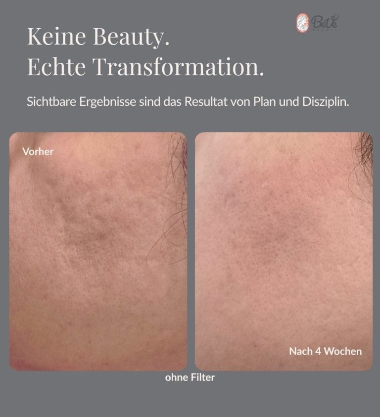 Akne und Akne Narben Behandlung in Hanau bei BeVe Beauty Akne Narben Behandlung in Hanau bei BeVe Beauty
