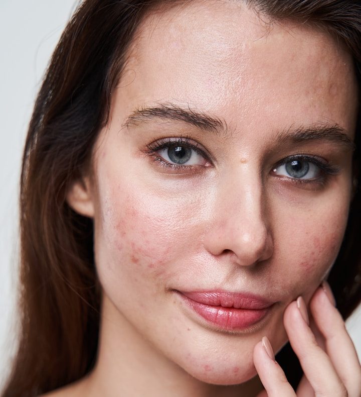 Akne und Akne Narben Behandlung in Hanau bei BeVe Beauty Akne Narben Behandlung in Hanau bei BeVe Beauty